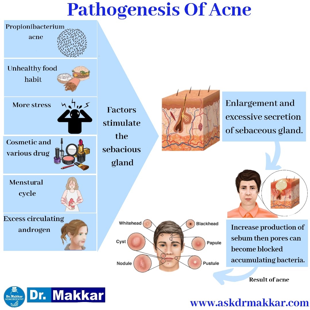 Acne Pathogenesis Homeoapathic approach by Dr Makkar Causes of Acne || मुँहासे के कारण