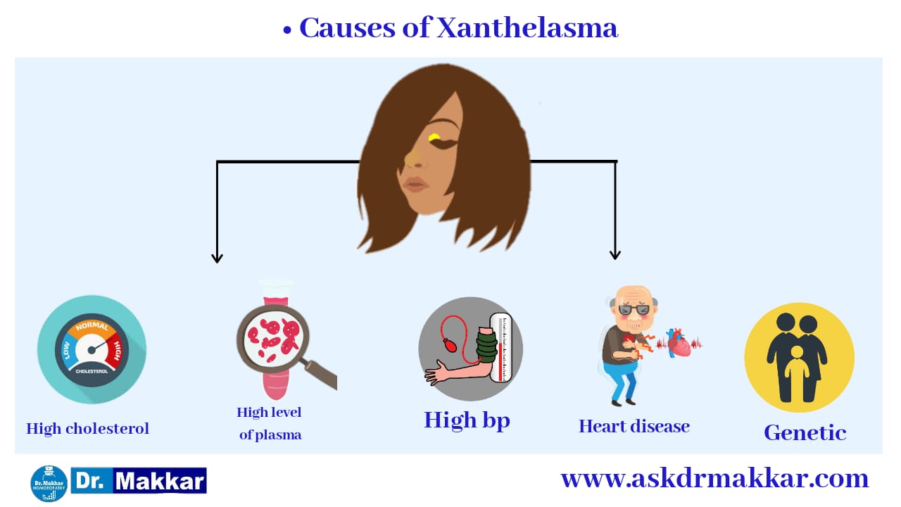 Causes of xanthelesma