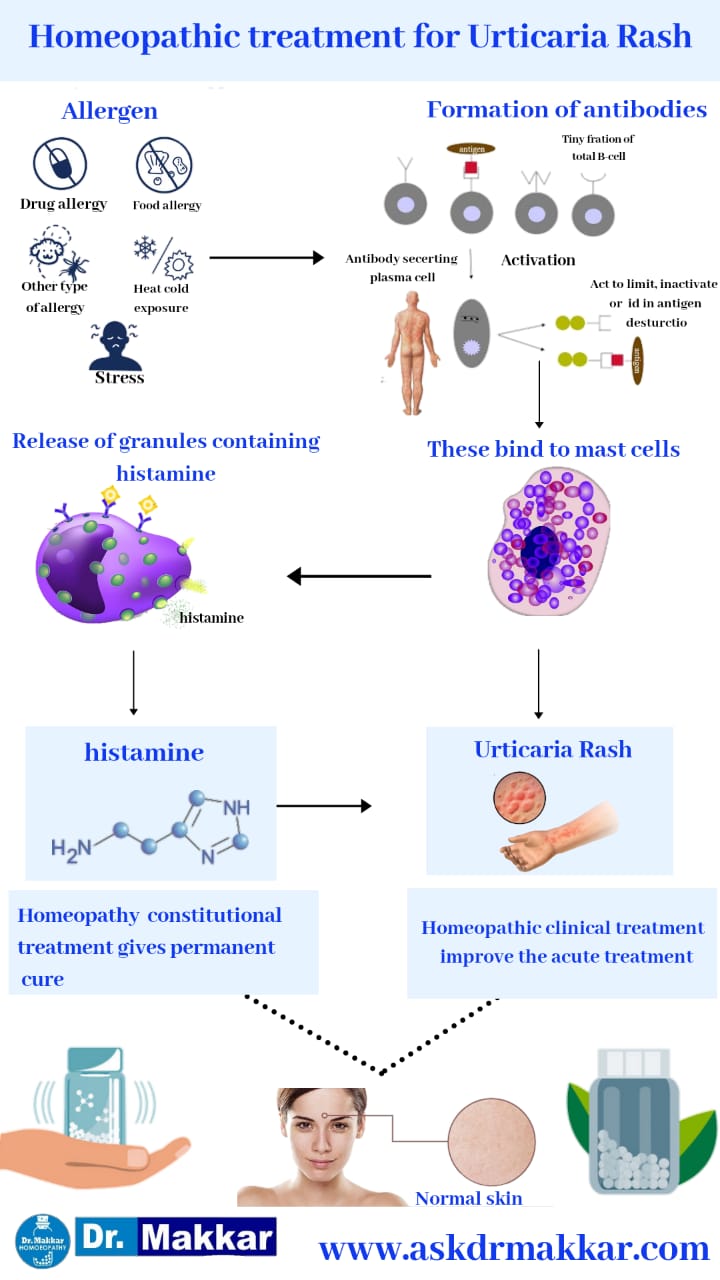 Urticarial rash occur skin allergy homeopathic approach