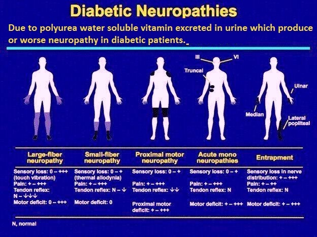 Diabetic Neuropathy