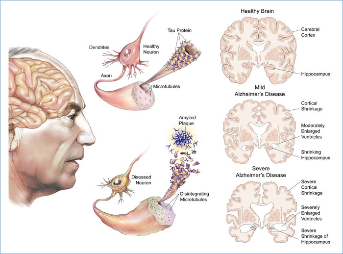 Alzheimer disease homoeopathic treatment