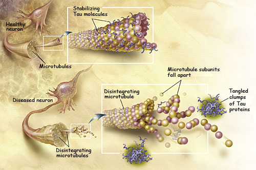 Alzheimer disease homoeopathic treatment