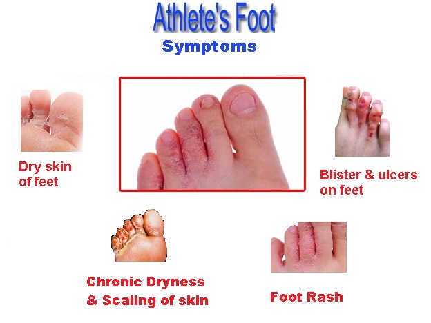 classical signs of Athlete foot symptoms