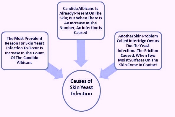 Cause of yeast infection in vagina in females 