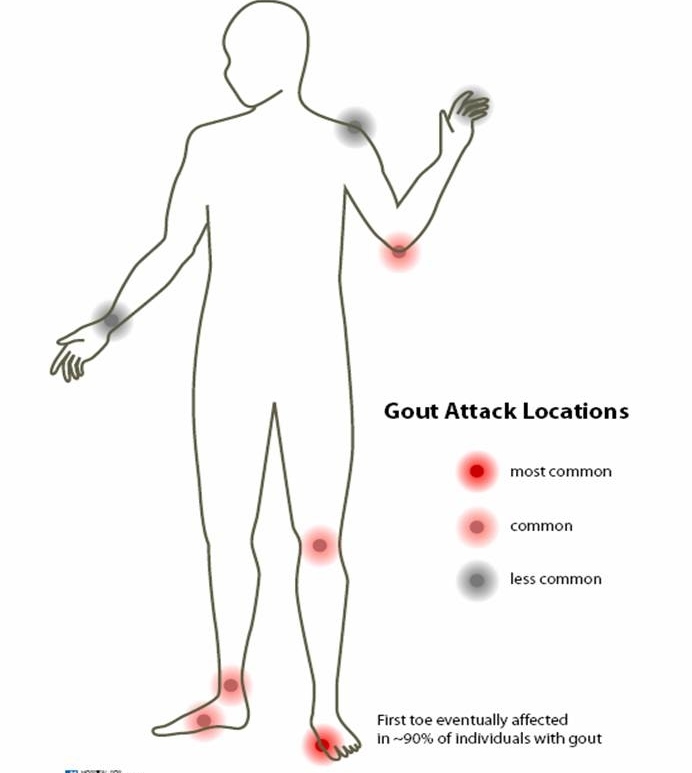 Location of gout effecting different parts of body