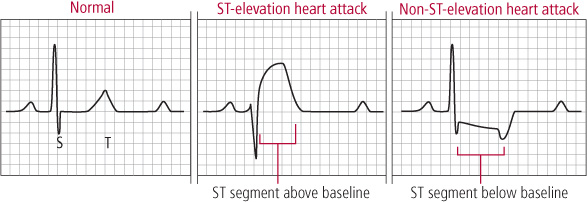 Heart attack ECG E.C.G. in Heart Attack Patient ||  ई सी जी हार्ट अटैक के रोगी में