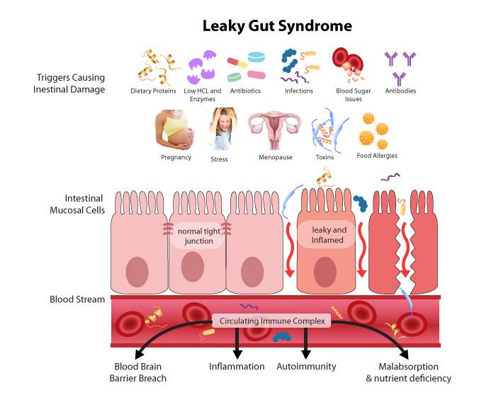 leaky gut leads to ibs lead to stress lead to autoimmune disorders