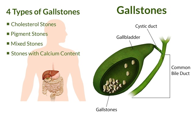 Liver gall bladder stones types