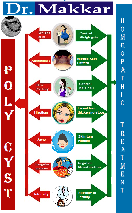 Poly_cyst_ovarian PCOS homeopathic treatment PCOD