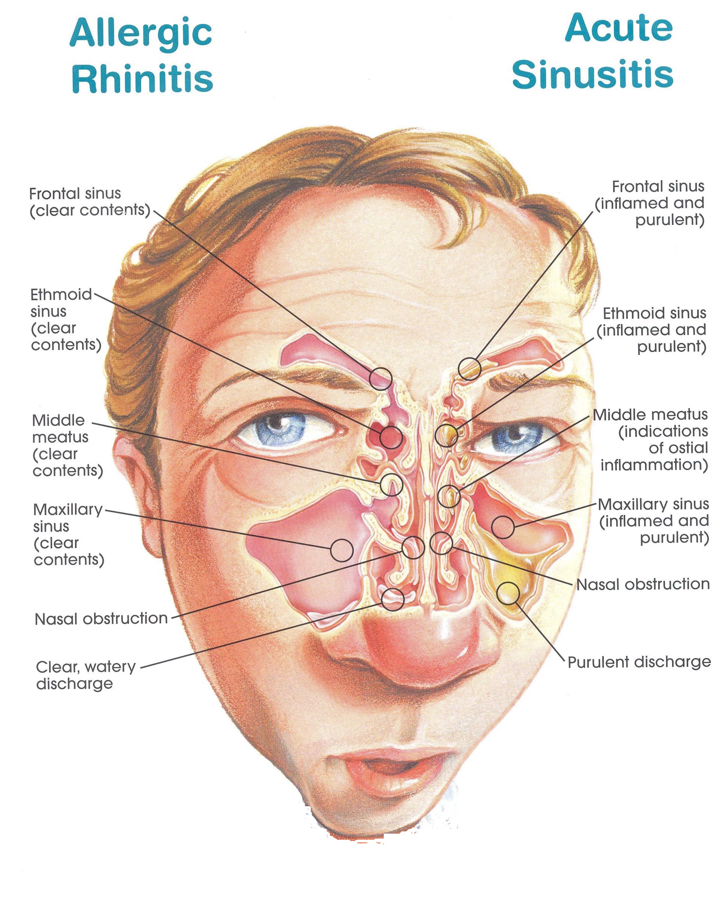 Sinusitis vs Rhinitis diffrence