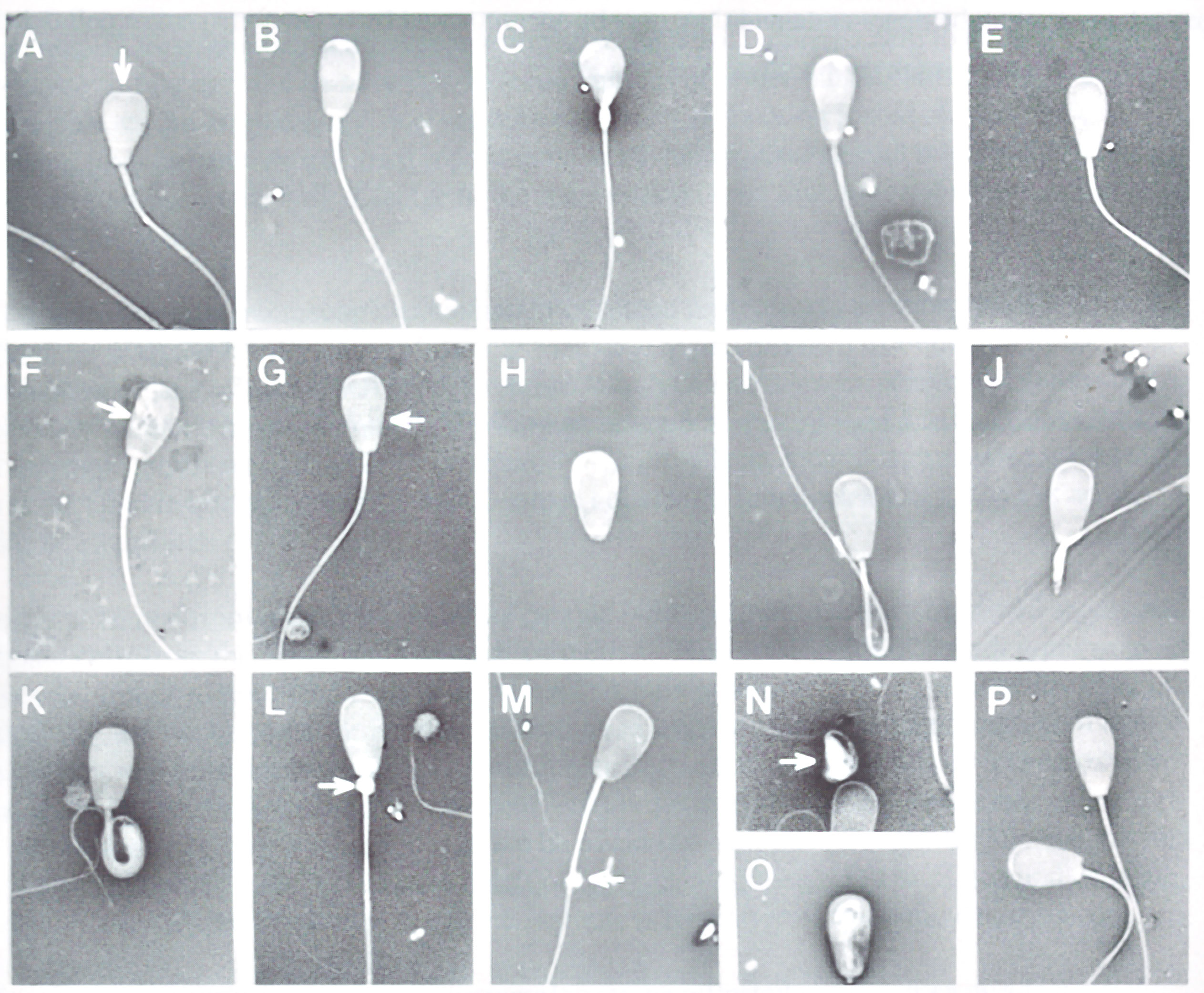 Typre of sperm leads to Azospermia