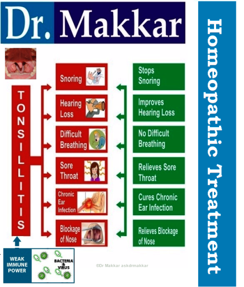 Tonsillitus Homeopathic approach to Treatment