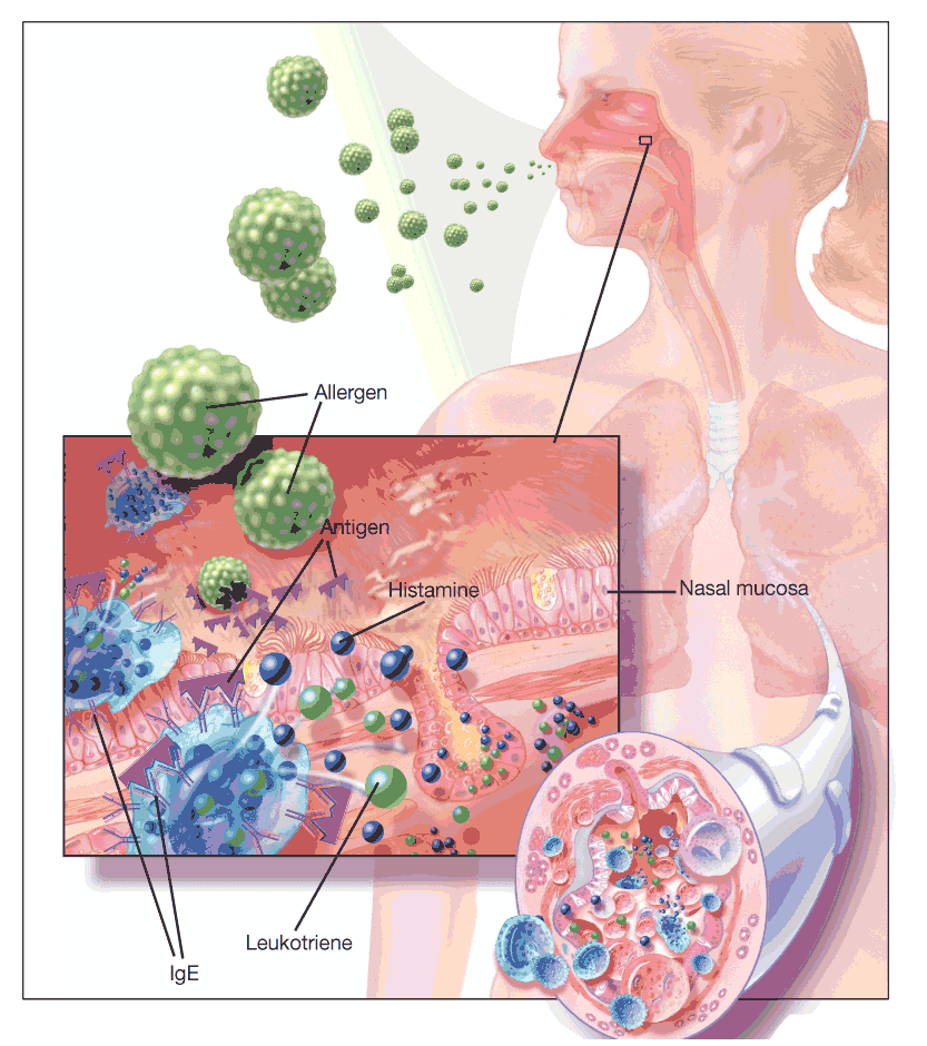 Asthma is complex disease part of immuno deficiency