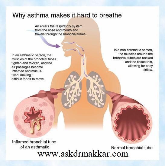 why & how asthma make breathing difficulty