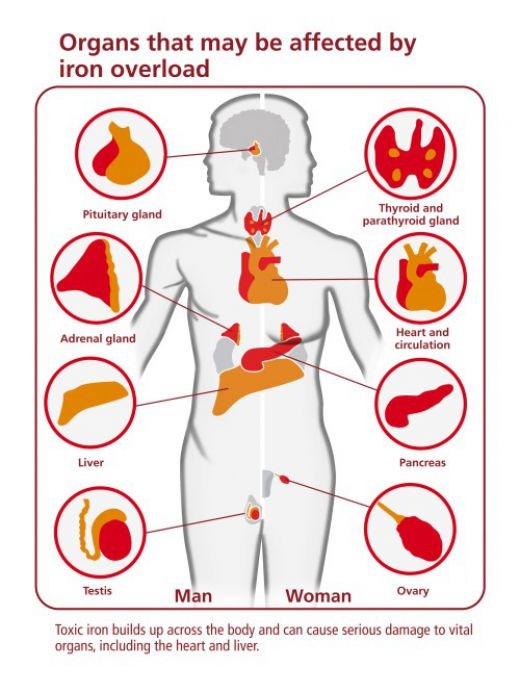 Thallasemia complication