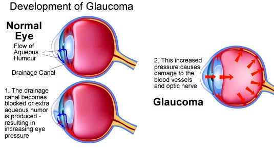 Glaucoma how develop in eye