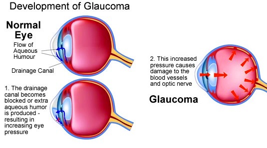 Glaucoma how develop in eye