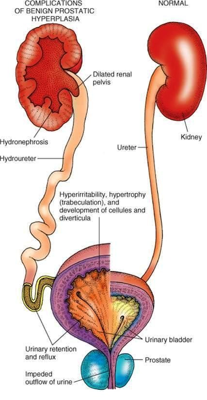 Enlarge prostrate types & complication