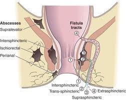 Type of fistula 