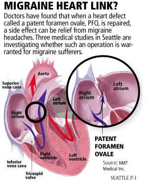 Migraine heart connection