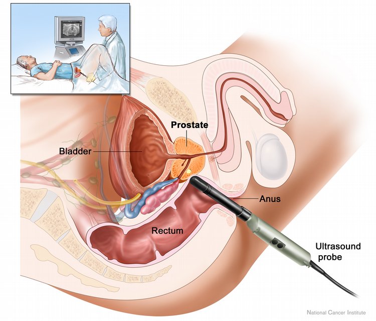 rectal ultrasound