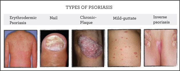 Differnt types of psoriasis