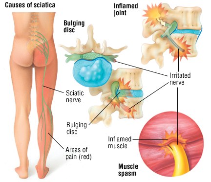 Slipped disc or sciatica or  nerve compression if left untreated