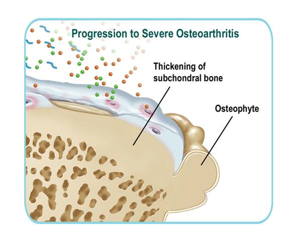 Progression of osteoarthritis