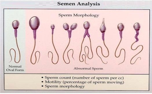 Sperm Morphology normal vs abnormal sperm