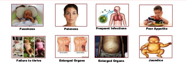 Symptoms of Thalassemia • Fatigue  • Headache  • Weakness   • Growth failure  • Shortness of breath  • Pale appearance  • Irritability  • Jaundice  • Dark urine  • Facial bone deformities  • Slow growth  • Abdominal swelling  • Irregular menses  • Zinc deficiency