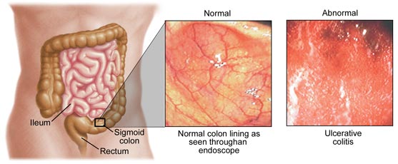 Normal vs Abnormal colon in Ulcerativve Colitis