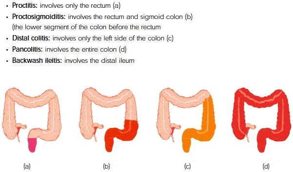 Ulcerative colitis vs crohns disease