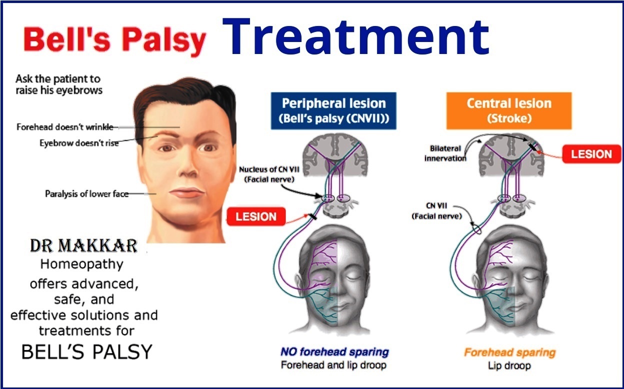 Idiopathic facial nerve paralysis cocker spaniel