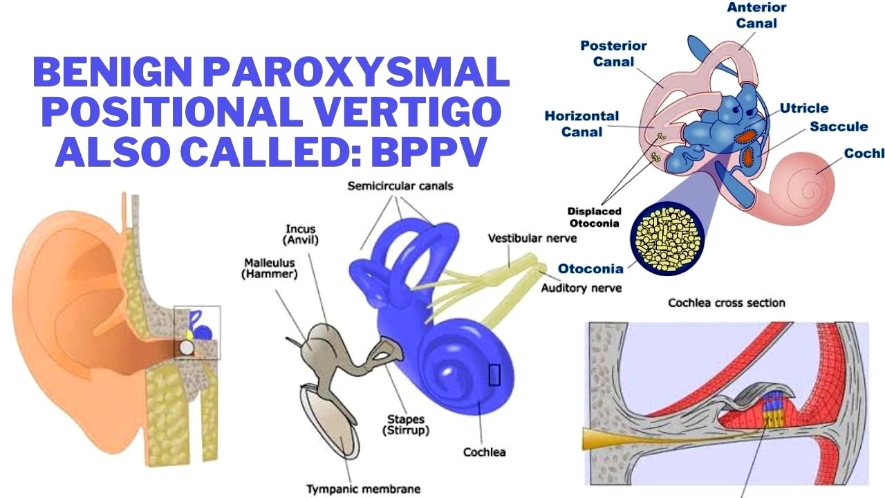 Positional vertigo causes