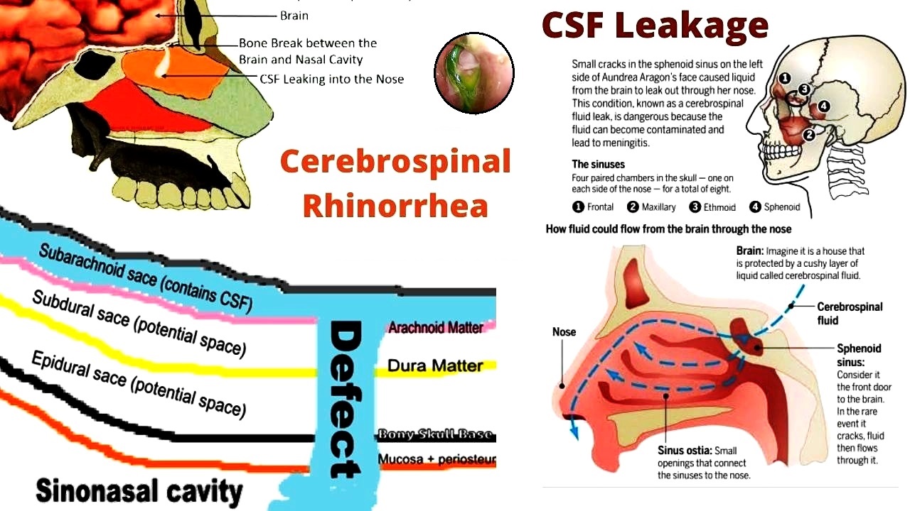Cerebrospinal fluid leak