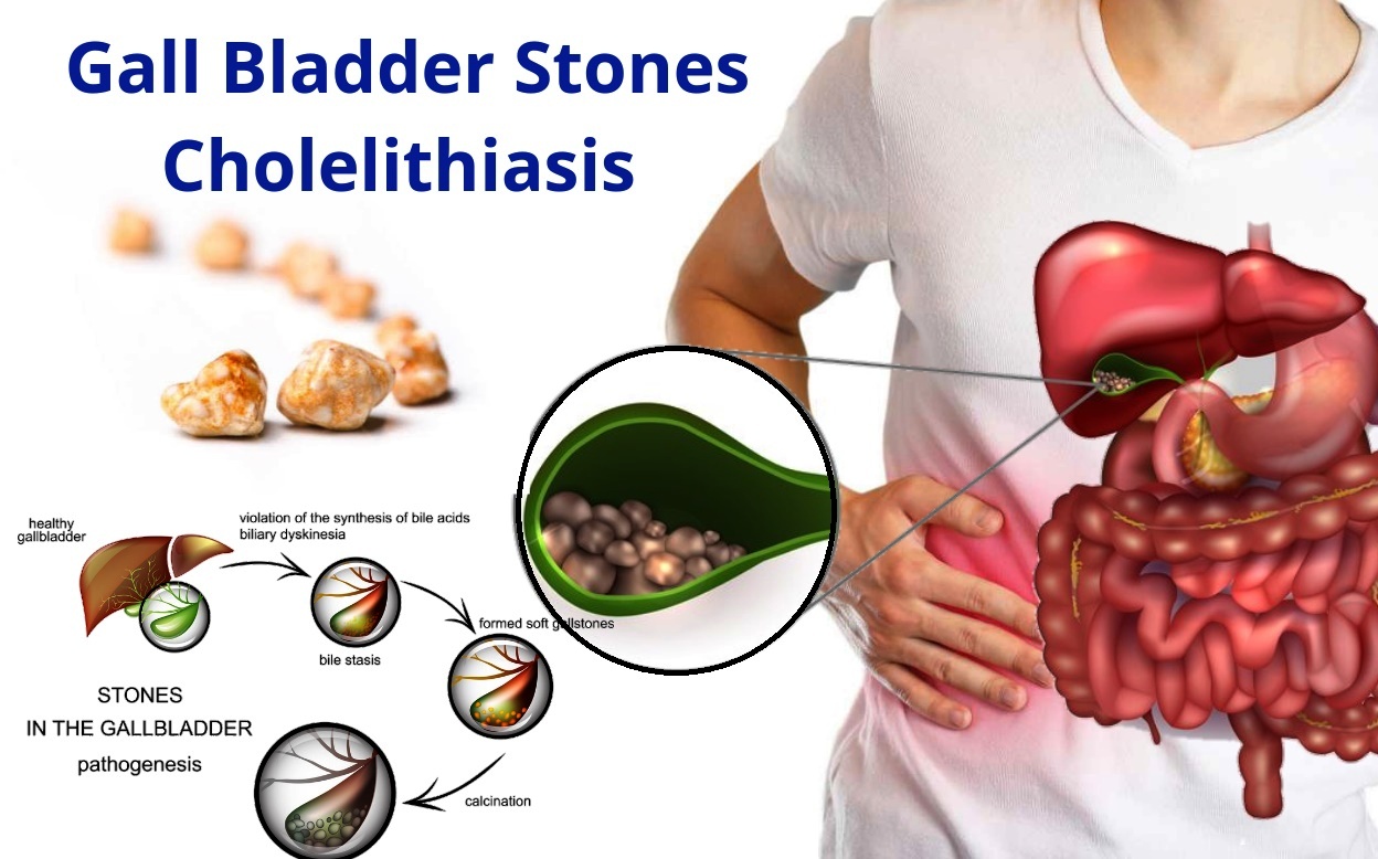 Gallstones Cholelithesis Homeopathic Treatment Gall Bladder Stone