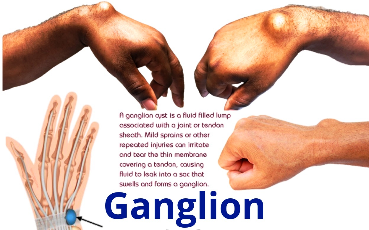 Cyst ganglion cure for Nonsurgical Treatment