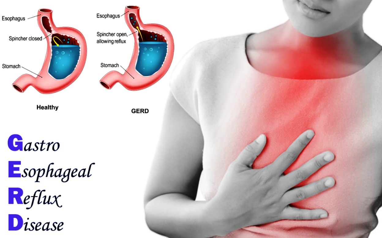 Gastro-esophageal reflux or GERD treatment in Stomach with ...