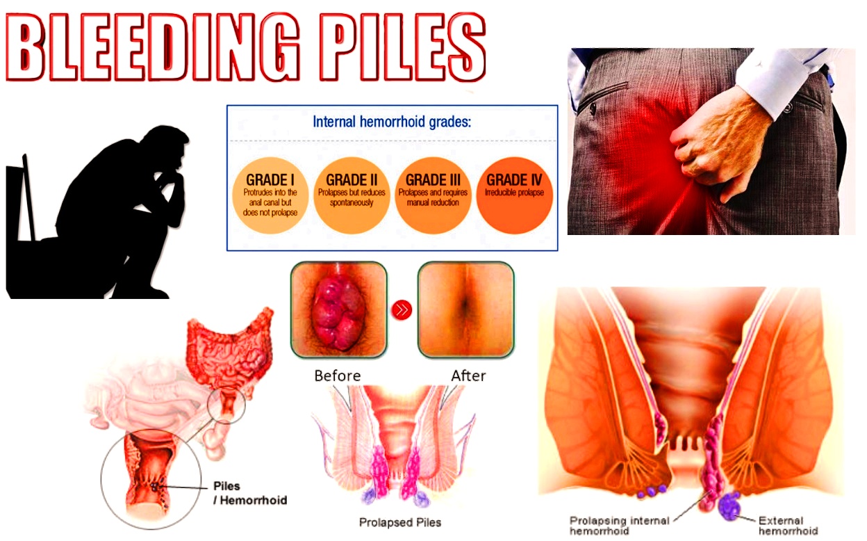 Rectum as related to Hemorrhoids Pictures