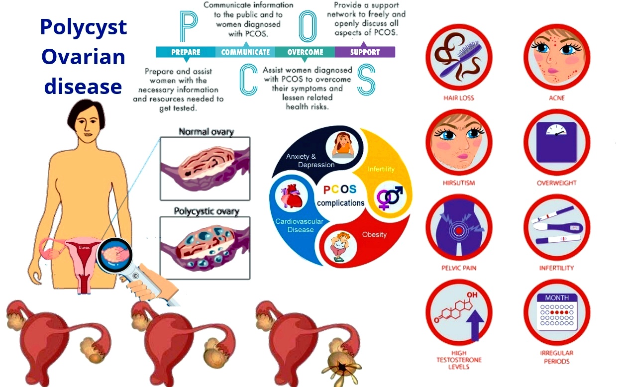 Pcos Cysts On Ovaries