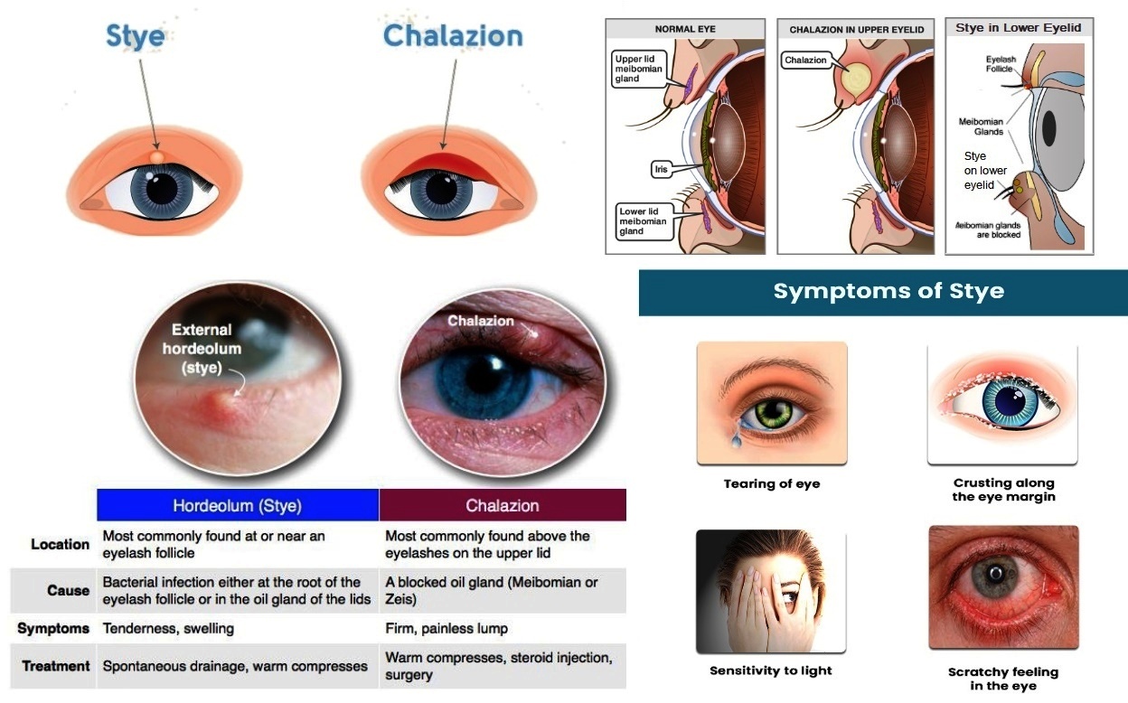 Difference Between A Stye And Chalazion TVHG Difference Between A Stye And Chalazion TVHG