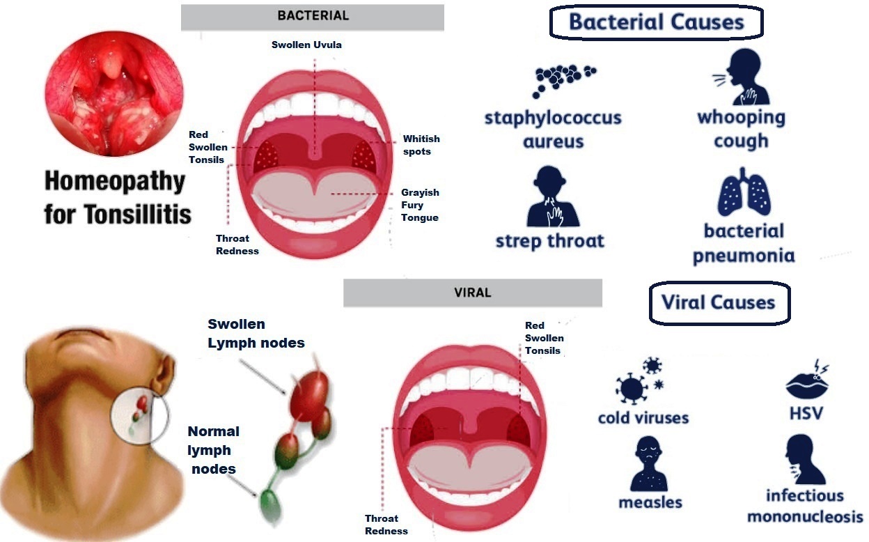 Viral Inflamed Tonsils