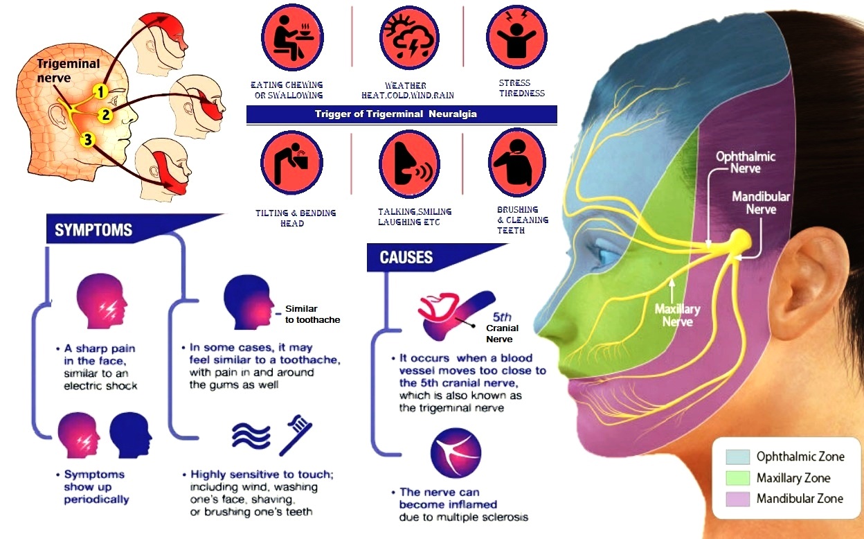 Trigeminal Neuralgia Treatment