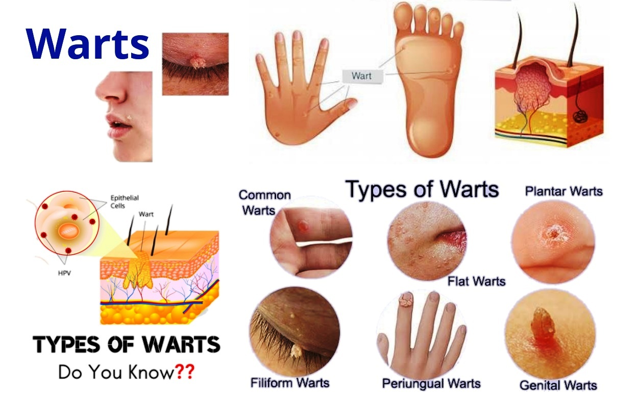 Warts Homeopathy Skin Tag Plantar Wart Genital Warts Foot Corn Causes Symptom Homeopathic Treatment Best Medicine