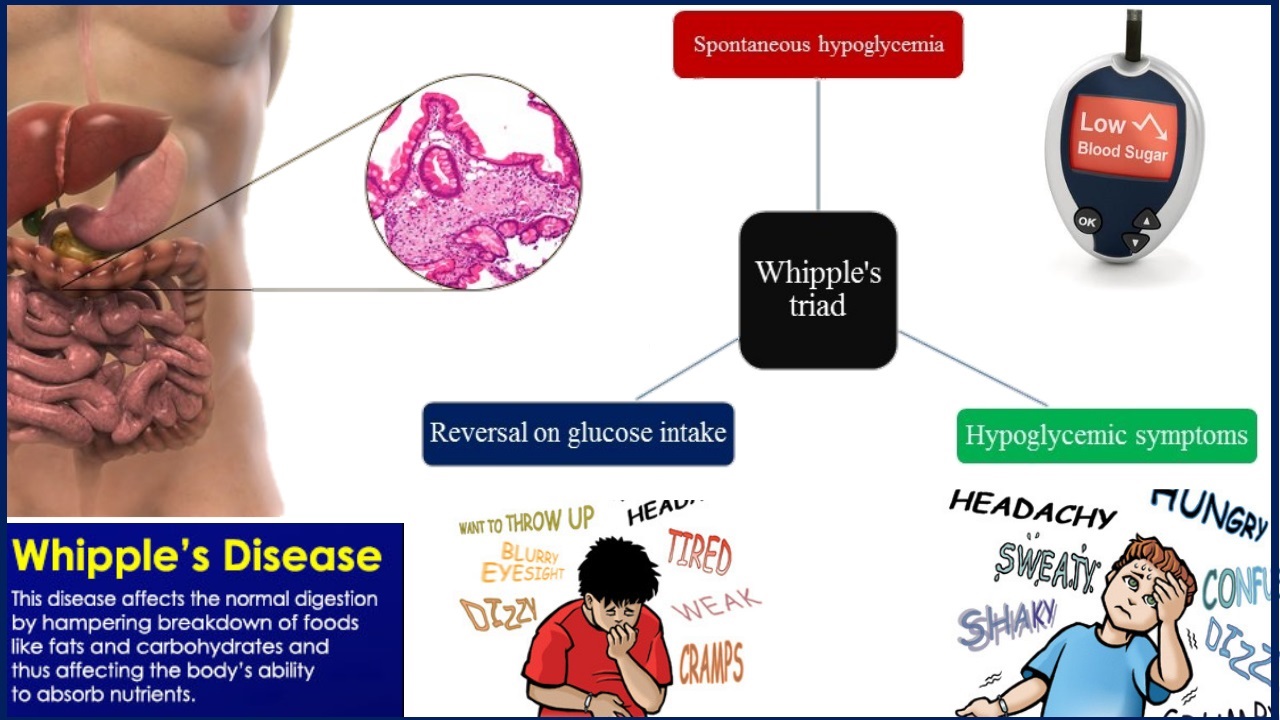 Whipple disease Homeopathic Treatment