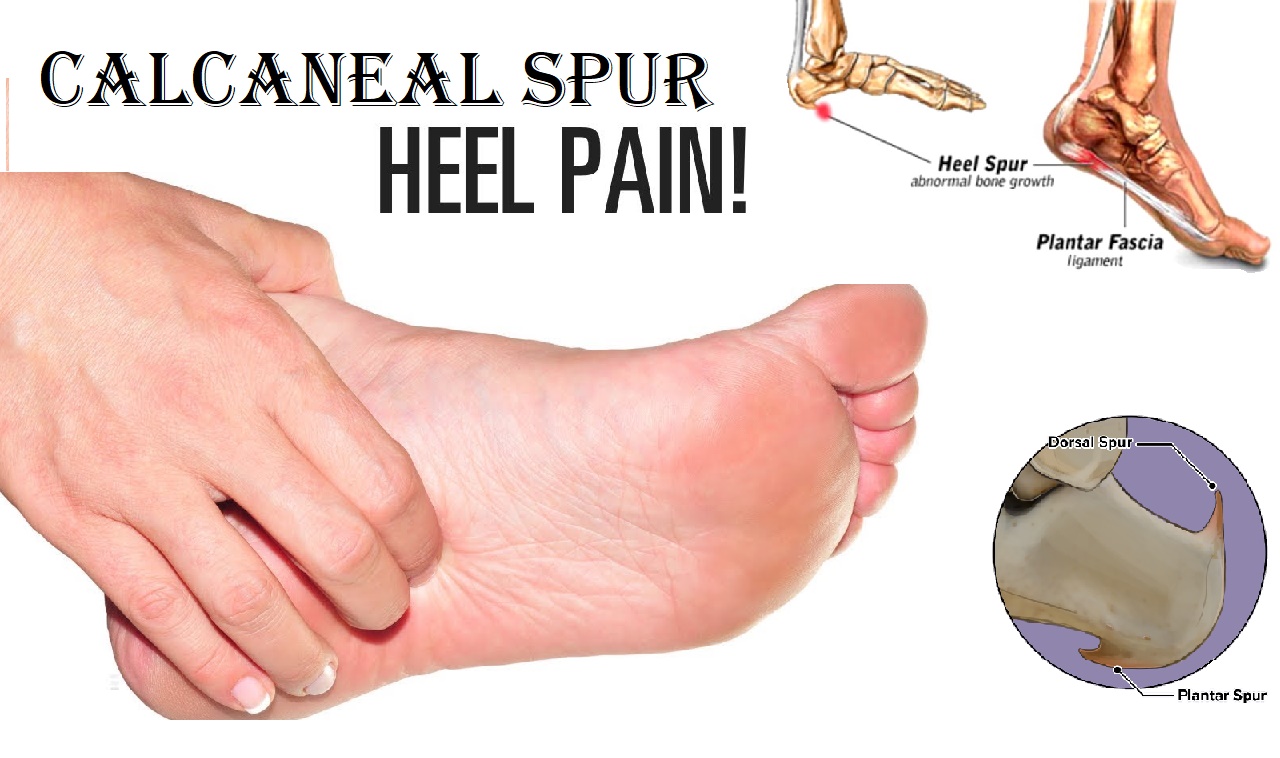 homeo medicine for heel spur